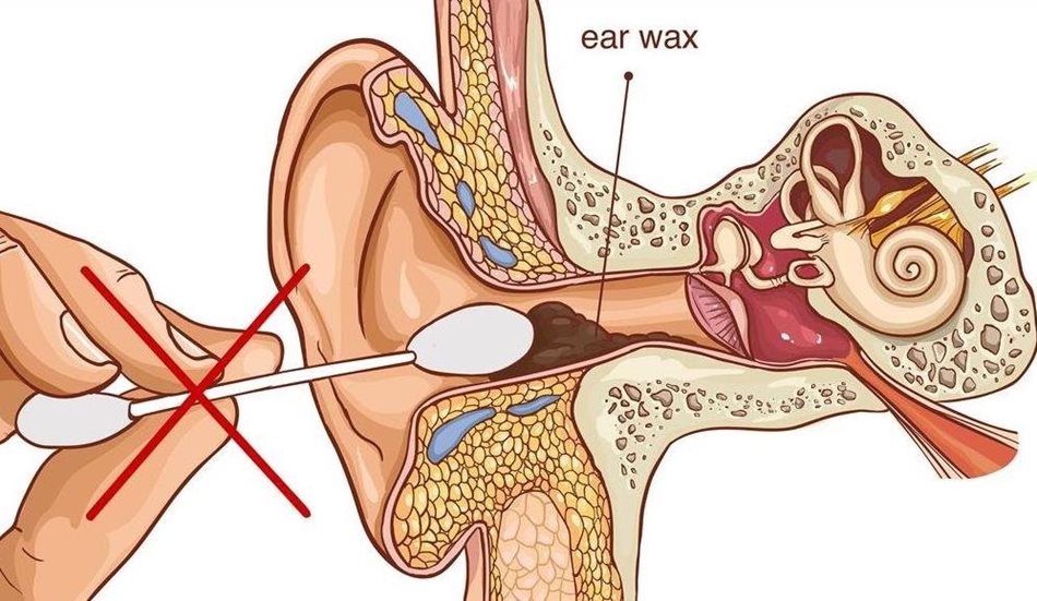 Tout savoir sur les bouchons de cérumen dans l'oreille - Quies